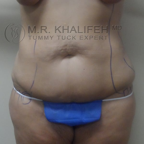 Tummy Tuck Gallery - Patient 3762239 - Image 1