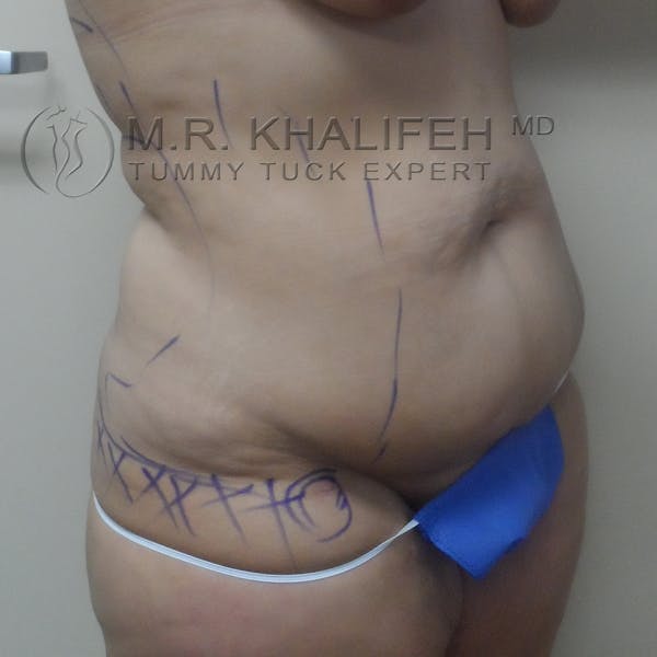 Tummy Tuck Gallery - Patient 3762239 - Image 3