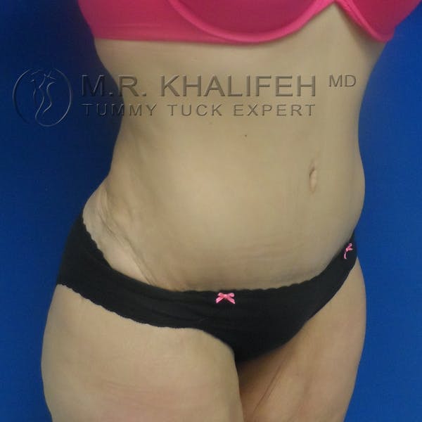 Tummy Tuck Gallery - Patient 3762239 - Image 4