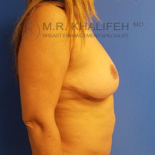 Breast Lift Gallery - Patient 3762236 - Image 5