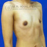 Breast Augmentation Gallery - Patient 3762242 - Image 1