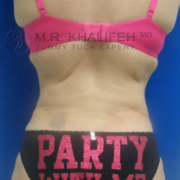 Tummy Tuck Gallery - Patient 3762239 - Image 8