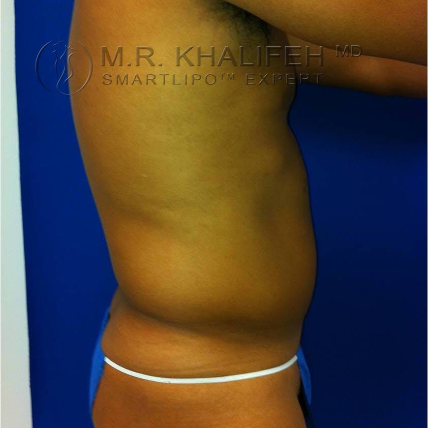 Male Liposuction Gallery - Patient 3762245 - Image 5