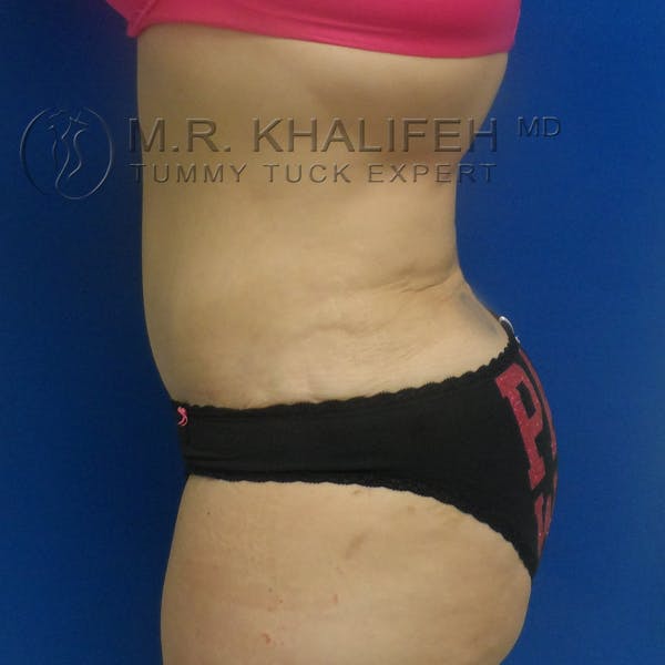 Tummy Tuck Gallery - Patient 3762239 - Image 10
