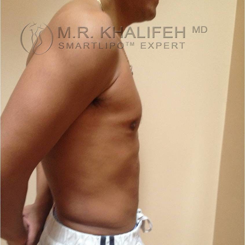 Male Liposuction Gallery - Patient 3762245 - Image 6