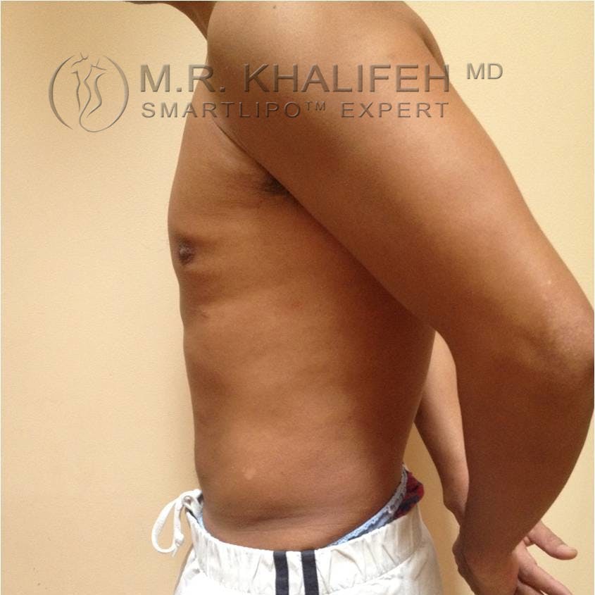 Male Liposuction Gallery - Patient 3762245 - Image 8