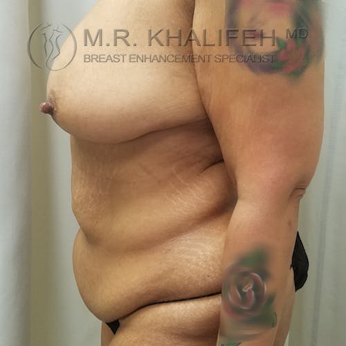 Breast Lift Gallery - Patient 3762246 - Image 5