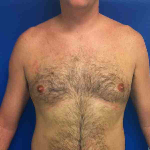Male Liposuction Gallery - Patient 3762250 - Image 1