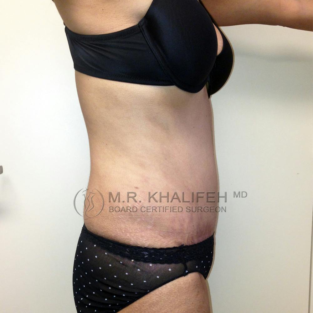 Tummy Tuck Gallery - Patient 3762249 - Image 4