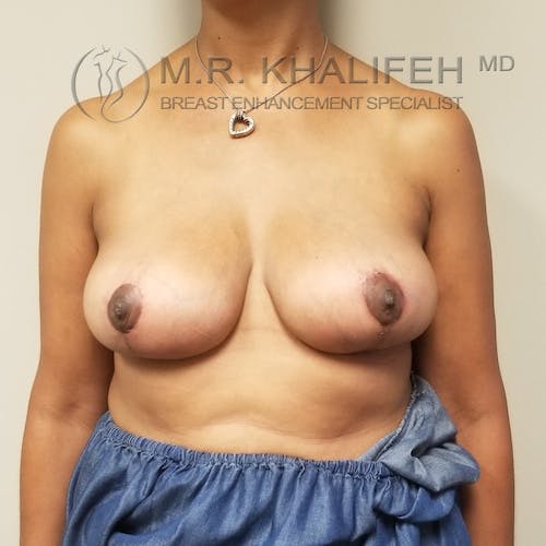 Breast Lift Gallery - Patient 3762251 - Image 2
