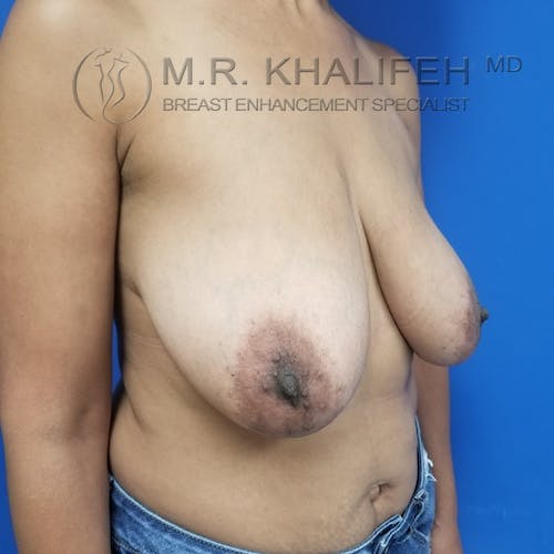 Breast Lift Gallery - Patient 3762251 - Image 3