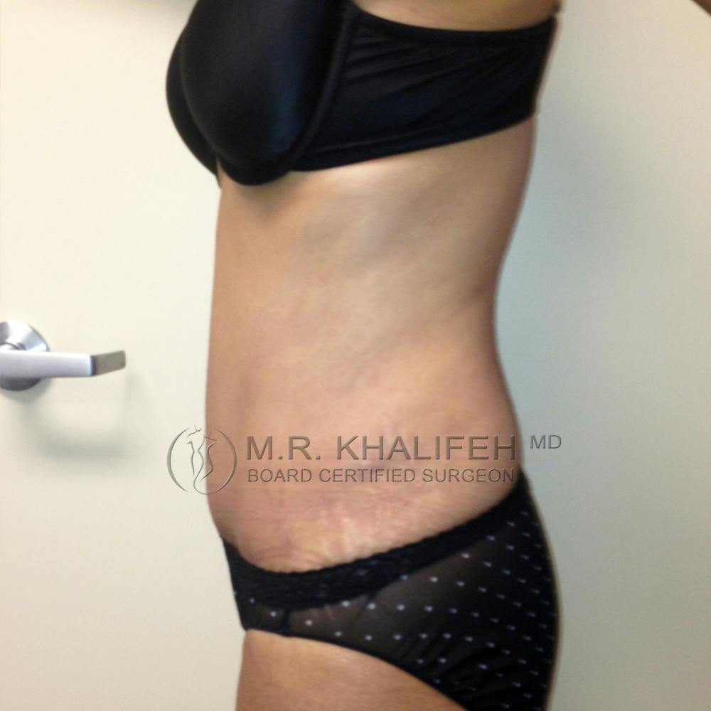 Tummy Tuck Gallery - Patient 3762249 - Image 6