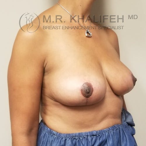 Breast Lift Gallery - Patient 3762251 - Image 4