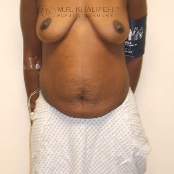 Tummy Tuck Gallery - Patient 3762259 - Image 1