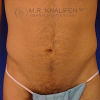 Male Liposuction Gallery - Patient 3762268 - Image 1