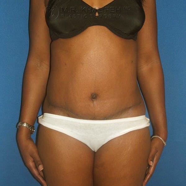 Tummy Tuck Gallery - Patient 3762259 - Image 2