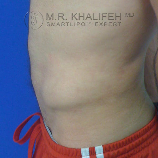 Male Liposuction Gallery - Patient 3762268 - Image 4