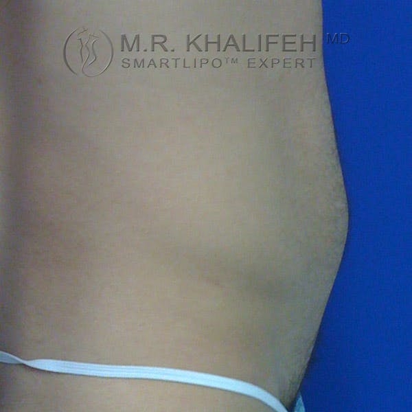 Male Liposuction Gallery - Patient 3762268 - Image 5