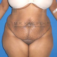 Tummy Tuck Gallery - Patient 3762275 - Image 1