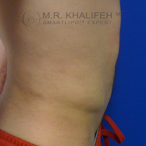 Male Liposuction Gallery - Patient 3762268 - Image 6