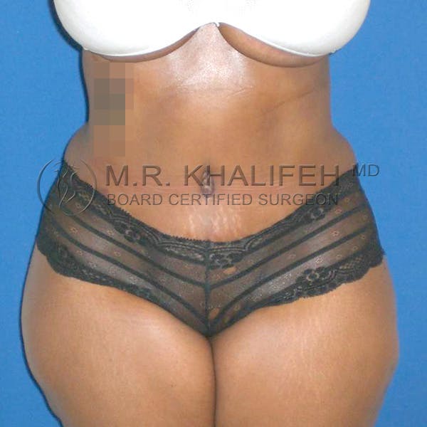 Tummy Tuck Gallery - Patient 3762275 - Image 2