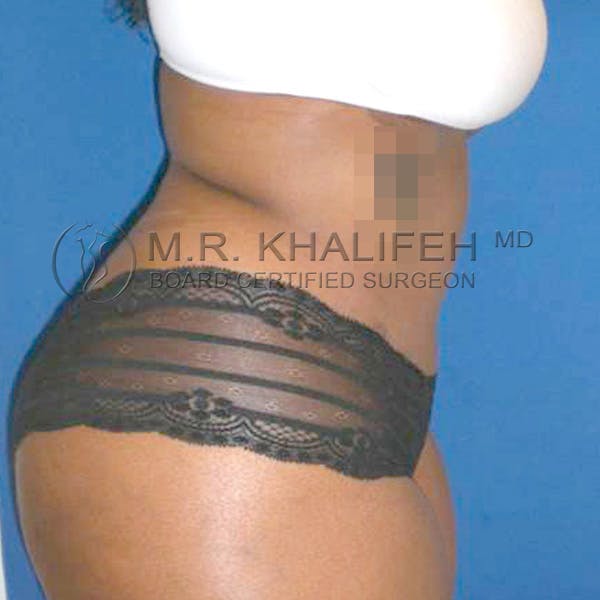 Tummy Tuck Gallery - Patient 3762275 - Image 4