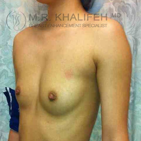 Breast Augmentation Gallery - Patient 3762287 - Image 3