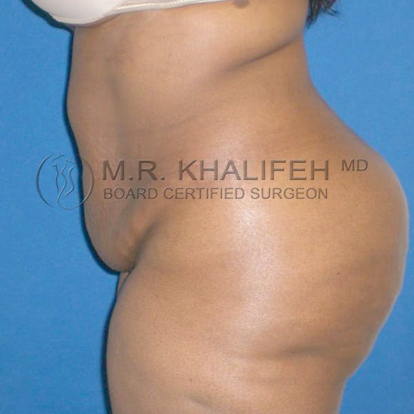 Tummy Tuck Gallery - Patient 3762275 - Image 5