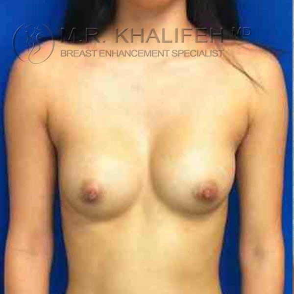 Breast Augmentation Gallery - Patient 3762287 - Image 6