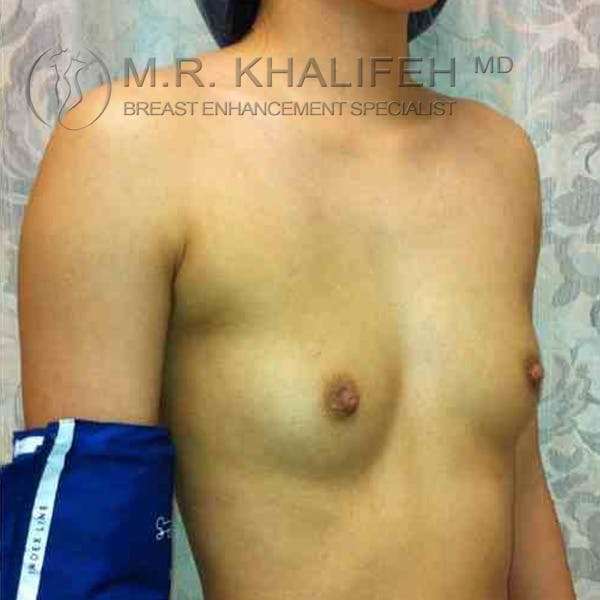 Breast Augmentation Gallery - Patient 3762287 - Image 7