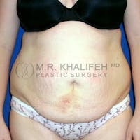 Tummy Tuck Gallery - Patient 3762298 - Image 1