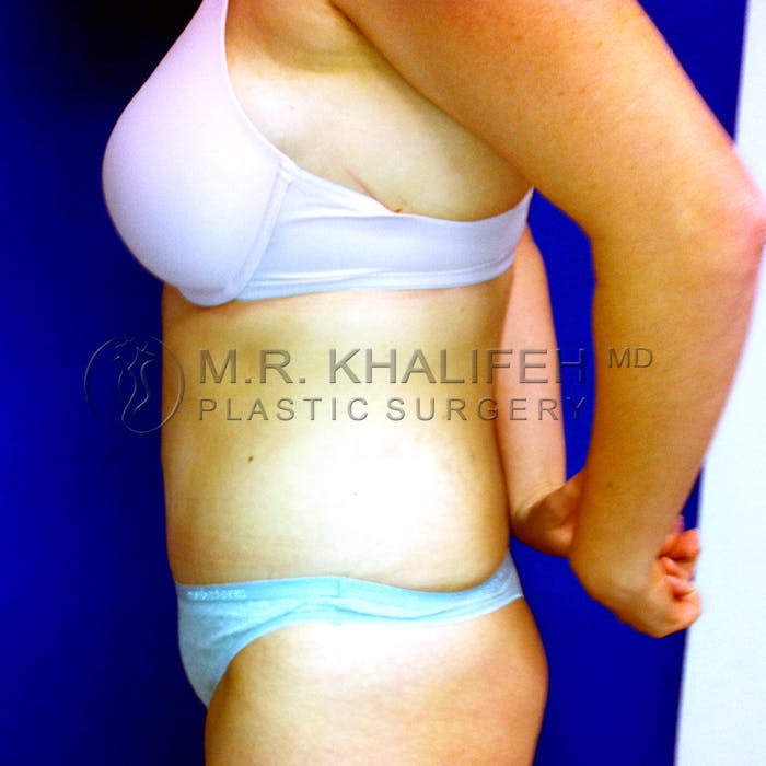Tummy Tuck Gallery - Patient 3762298 - Image 4