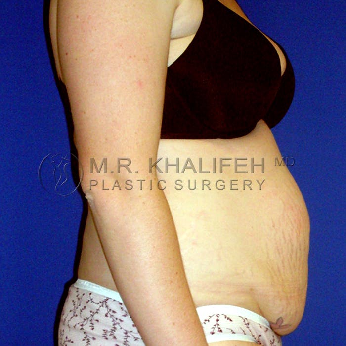 Tummy Tuck Gallery - Patient 3762298 - Image 5