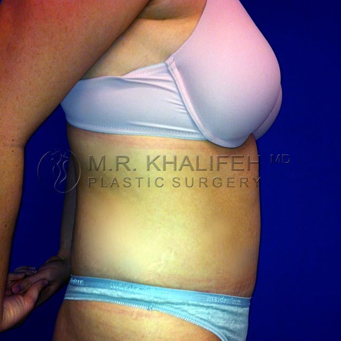 Tummy Tuck Gallery - Patient 3762298 - Image 6