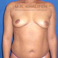 Breast Augmentation Gallery - Patient 3762316 - Image 1
