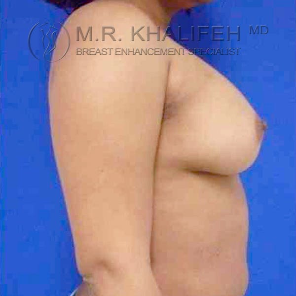 Breast Augmentation Gallery - Patient 3762316 - Image 4