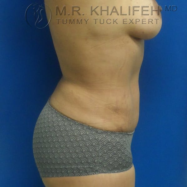 Tummy Tuck Gallery - Patient 3762325 - Image 10