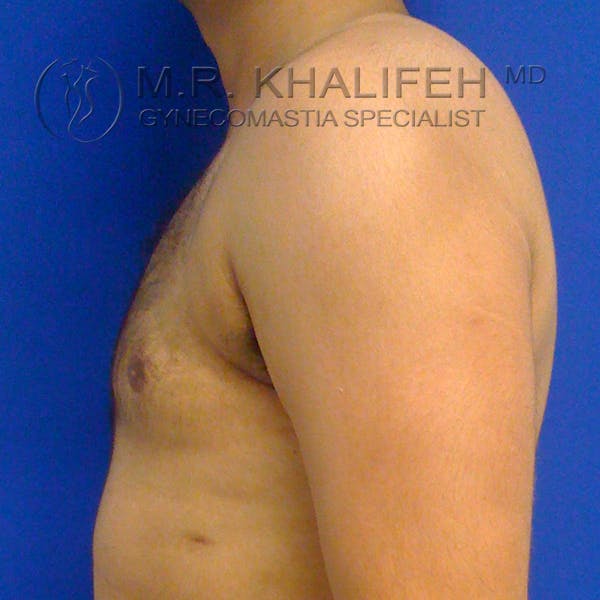 Gynecomastia Gallery - Patient 3762335 - Image 6