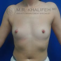 Breast Augmentation Gallery - Patient 3762350 - Image 1