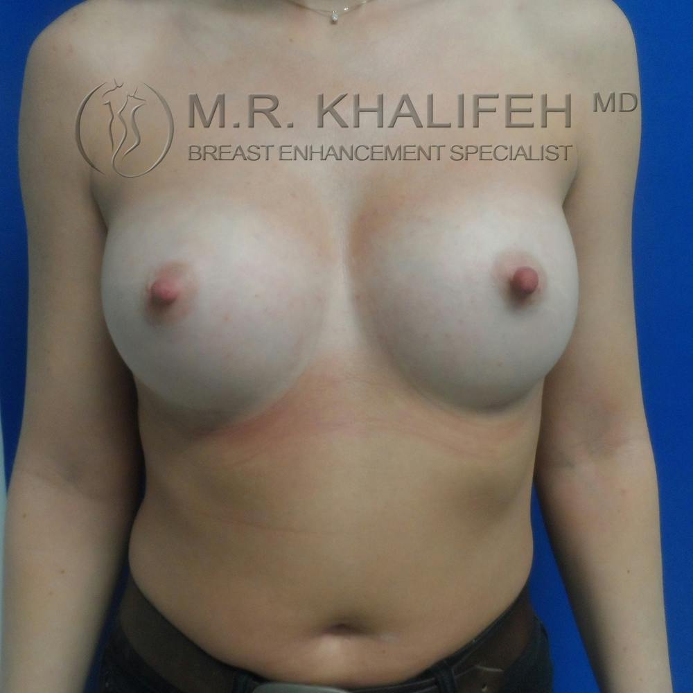 Breast Augmentation Gallery - Patient 3762350 - Image 2