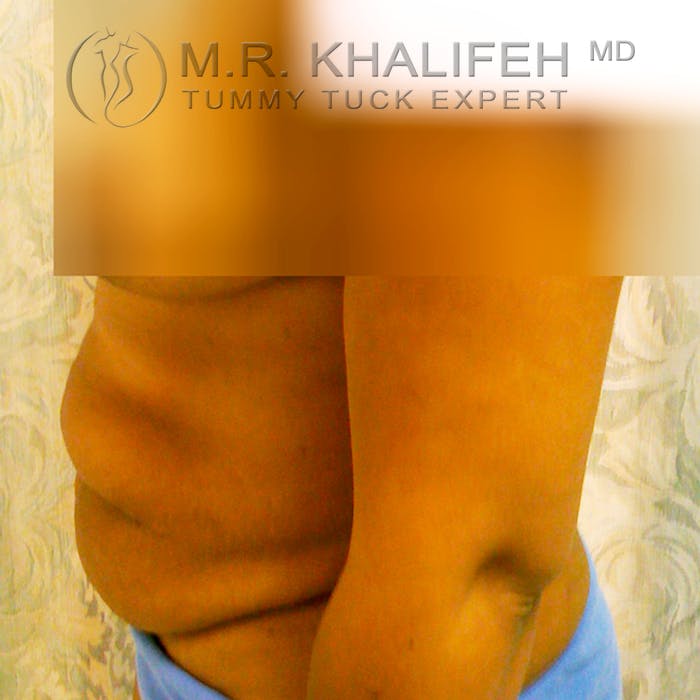 Tummy Tuck Gallery - Patient 3762344 - Image 5