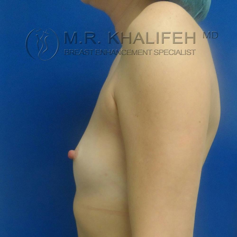 Breast Augmentation Gallery - Patient 3762350 - Image 3