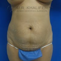 Tummy Tuck Gallery - Patient 3762351 - Image 1