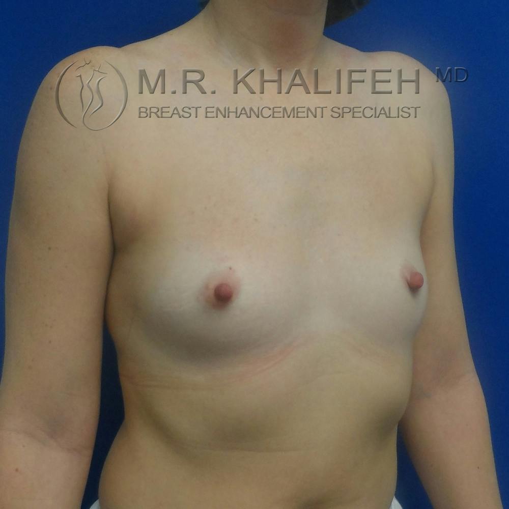 Breast Augmentation Gallery - Patient 3762350 - Image 7