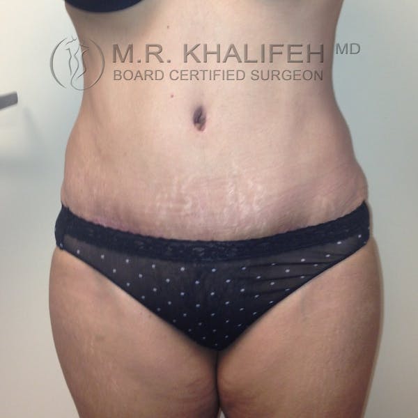 Tummy Tuck Gallery - Patient 3762351 - Image 2