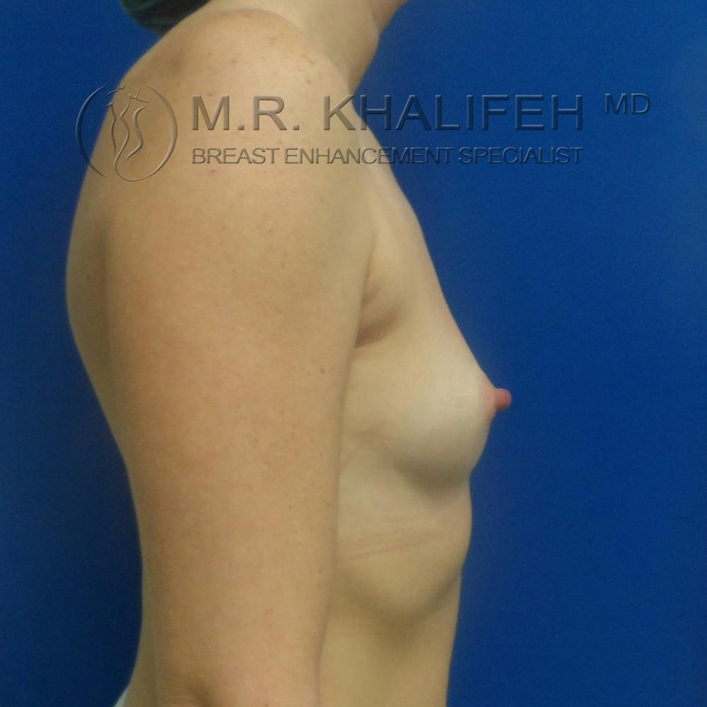 Breast Augmentation Gallery - Patient 3762350 - Image 9