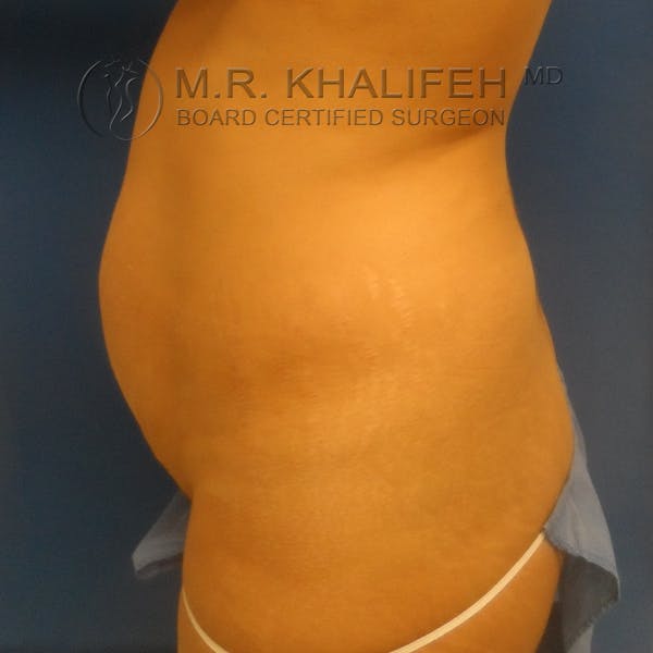 Tummy Tuck Gallery - Patient 3762351 - Image 5