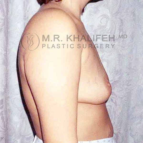 Breast Augmentation Gallery - Patient 3762359 - Image 5