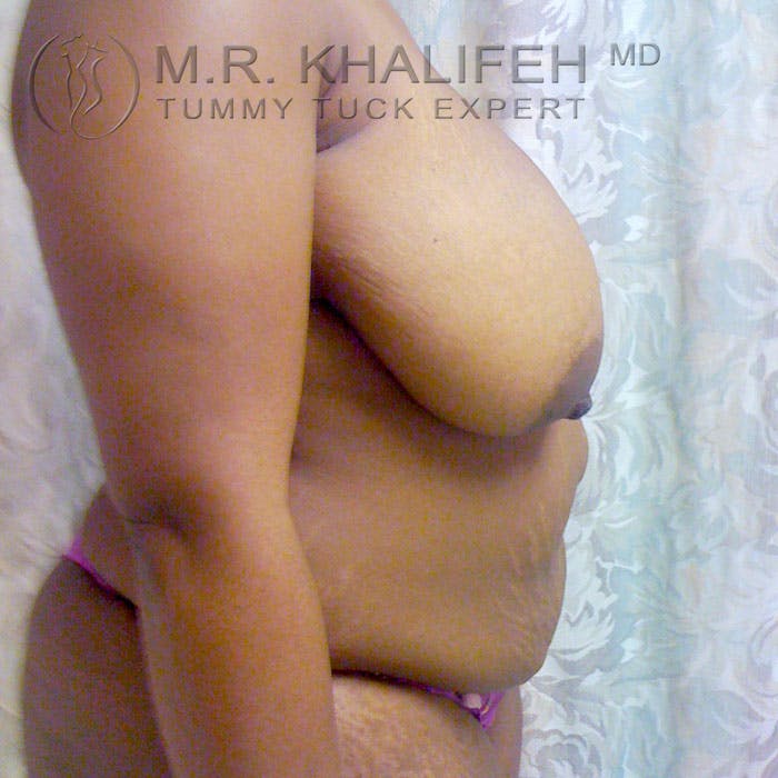 Tummy Tuck Gallery - Patient 3762361 - Image 5