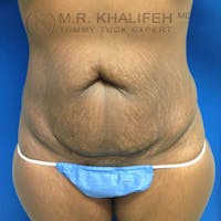 Tummy Tuck Gallery - Patient 3762366 - Image 1